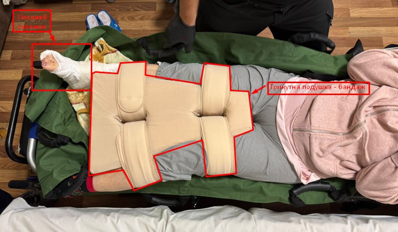 перелом шейки стегна